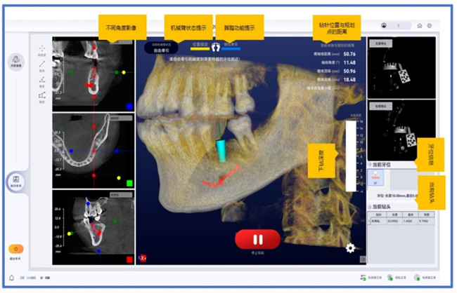 口腔种植手术机器人注册.jpg