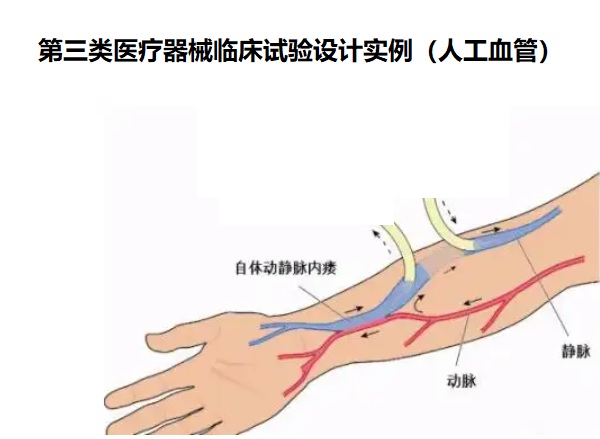 醫(yī)療器械臨床試驗(yàn)設(shè)計(jì).jpg